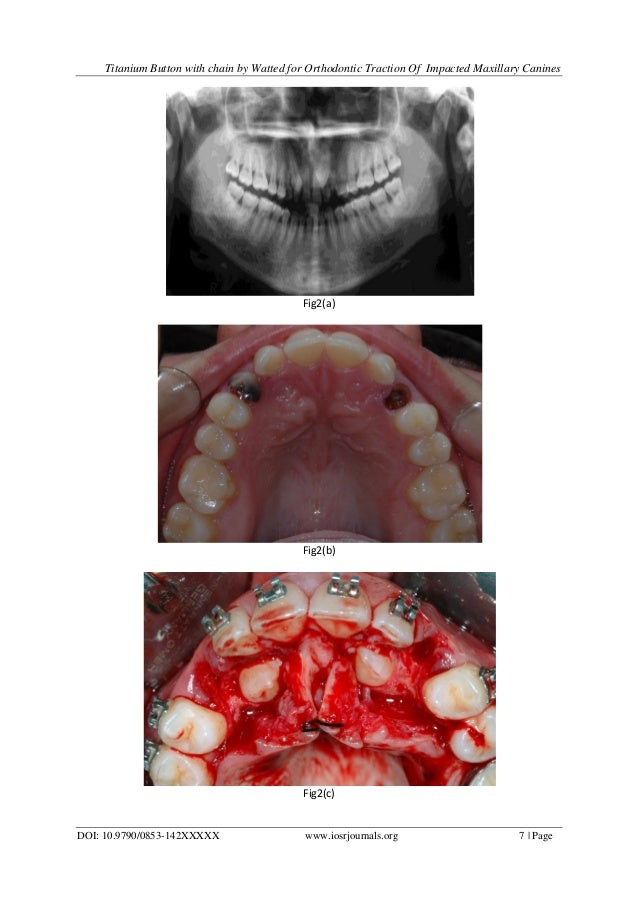 Titanium Button With Chain by Watted For Orthodontic Traction of Impa…