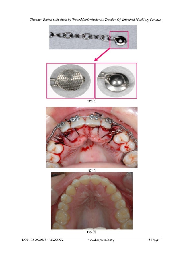 Titanium Button With Chain by Watted For Orthodontic Traction of Impa…