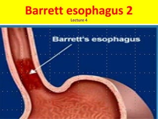 Barrett esophagus 2
Lecture 4
 