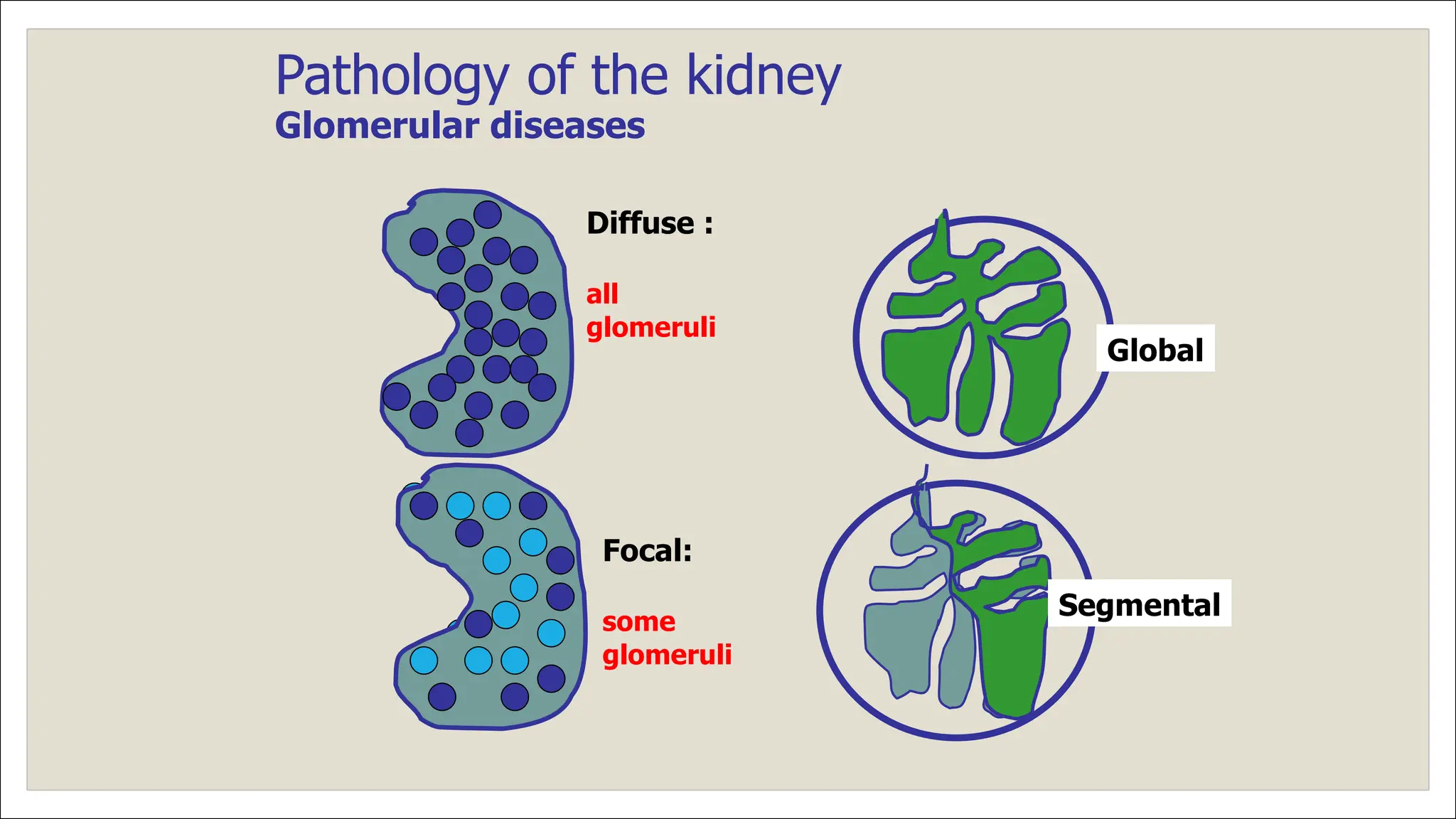 Pathology of the kidney
Glomerular diseases
Diffuse :
all
glomeruli
Focal:
some
glomeruli
Global
Segmental
 