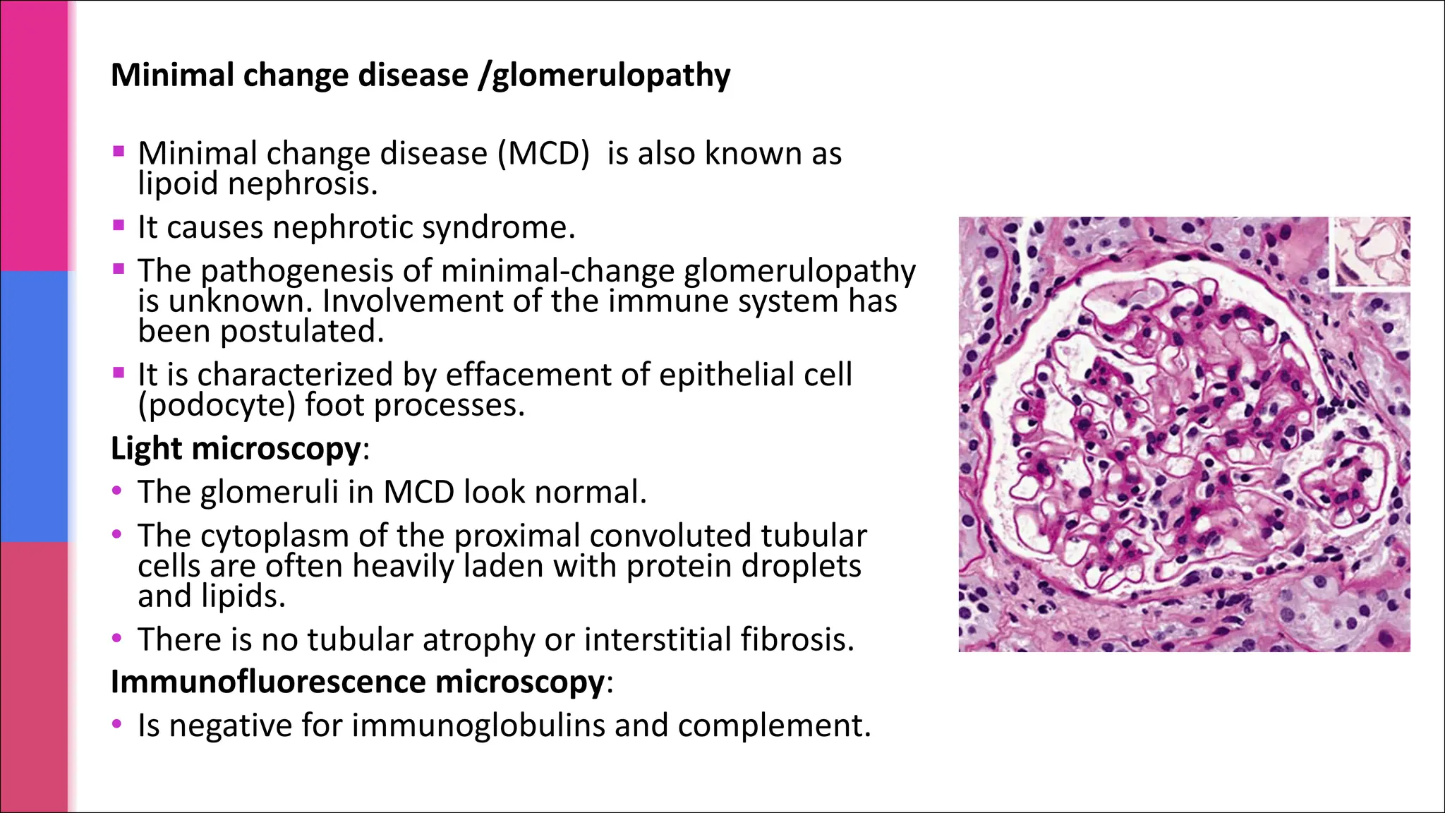 § Minimal change disease (MCD) is also known as
lipoid nephrosis.
§ It causes nephrotic syndrome.
§ The pathogenesis of minimal-change glomerulopathy
is unknown. Involvement of the immune system has
been postulated.
§ It is characterized by effacement of epithelial cell
(podocyte) foot processes.
Light microscopy:
• The glomeruli in MCD look normal.
• The cytoplasm of the proximal convoluted tubular
cells are often heavily laden with protein droplets
and lipids.
• There is no tubular atrophy or interstitial fibrosis.
Immunofluorescence microscopy:
• Is negative for immunoglobulins and complement.
Minimal change disease /glomerulopathy
 