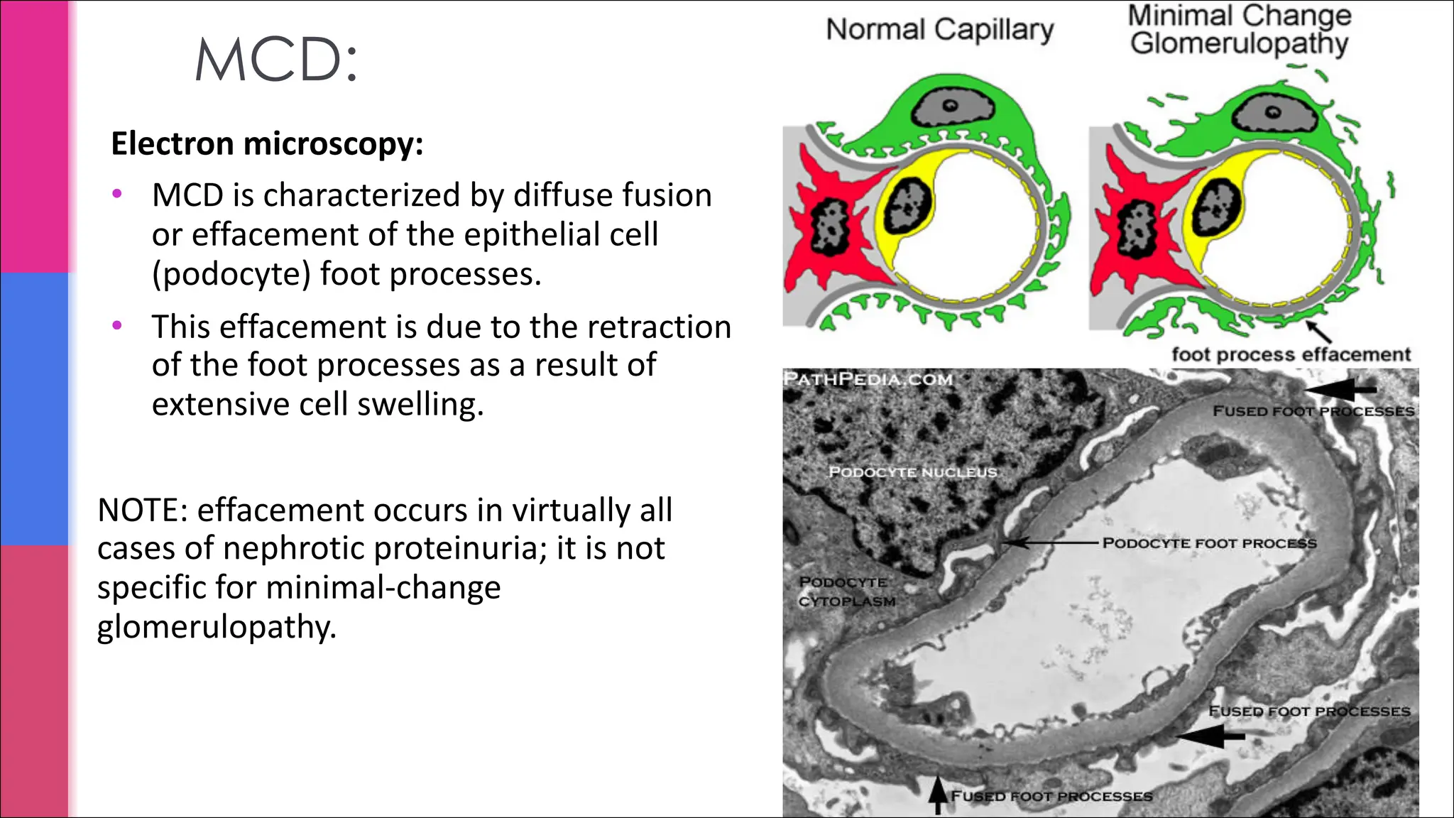 MCD:
Electron microscopy:
• MCD is characterized by diffuse fusion
or effacement of the epithelial cell
(podocyte) foot processes.
• This effacement is due to the retraction
of the foot processes as a result of
extensive cell swelling.
NOTE: effacement occurs in virtually all
cases of nephrotic proteinuria; it is not
specific for minimal-change
glomerulopathy.
 