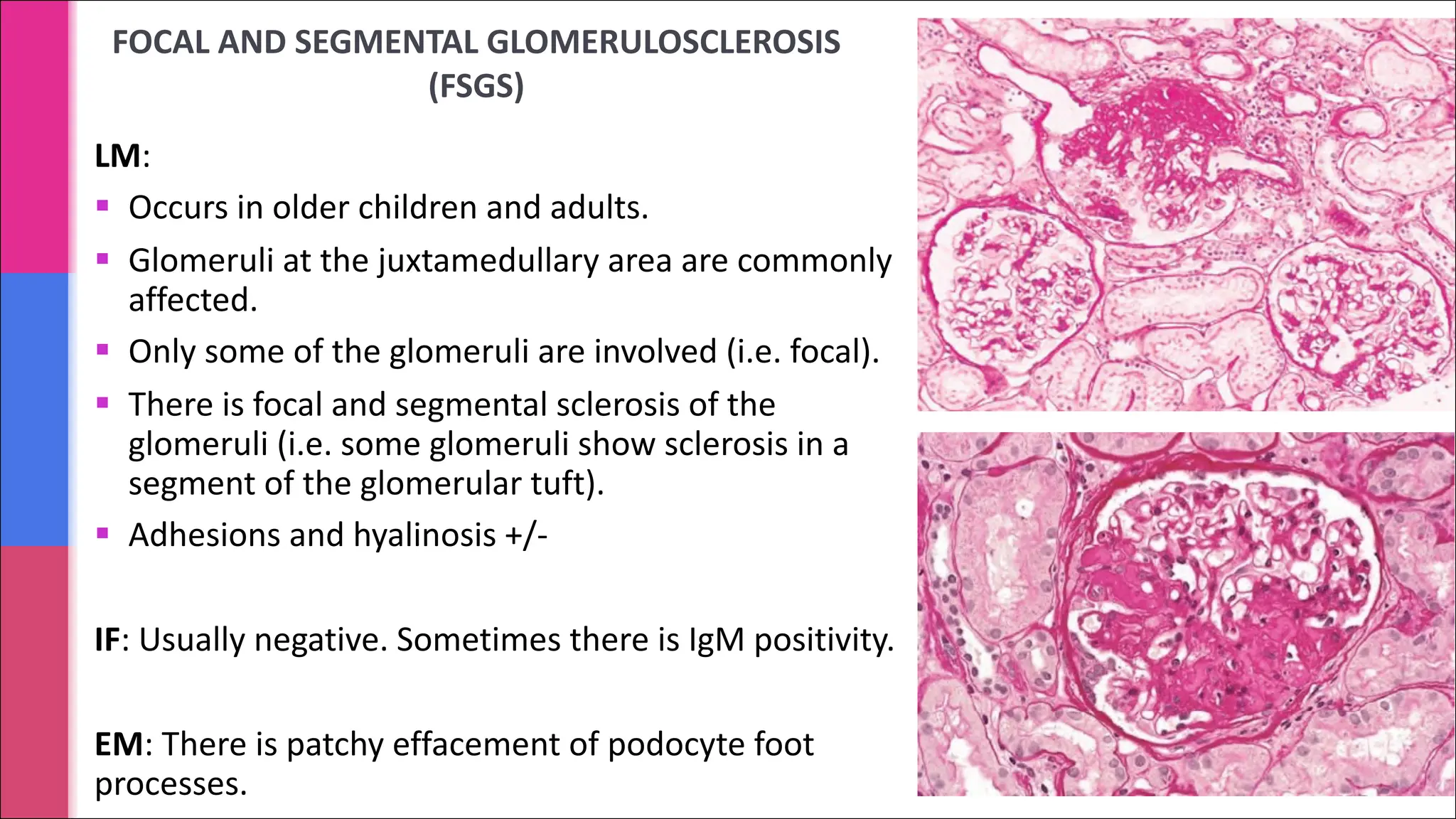 FOCAL AND SEGMENTAL GLOMERULOSCLEROSIS
(FSGS)
LM:
§ Occurs in older children and adults.
§ Glomeruli at the juxtamedullary area are commonly
affected.
§ Only some of the glomeruli are involved (i.e. focal).
§ There is focal and segmental sclerosis of the
glomeruli (i.e. some glomeruli show sclerosis in a
segment of the glomerular tuft).
§ Adhesions and hyalinosis +/-
IF: Usually negative. Sometimes there is IgM positivity.
EM: There is patchy effacement of podocyte foot
processes.
 