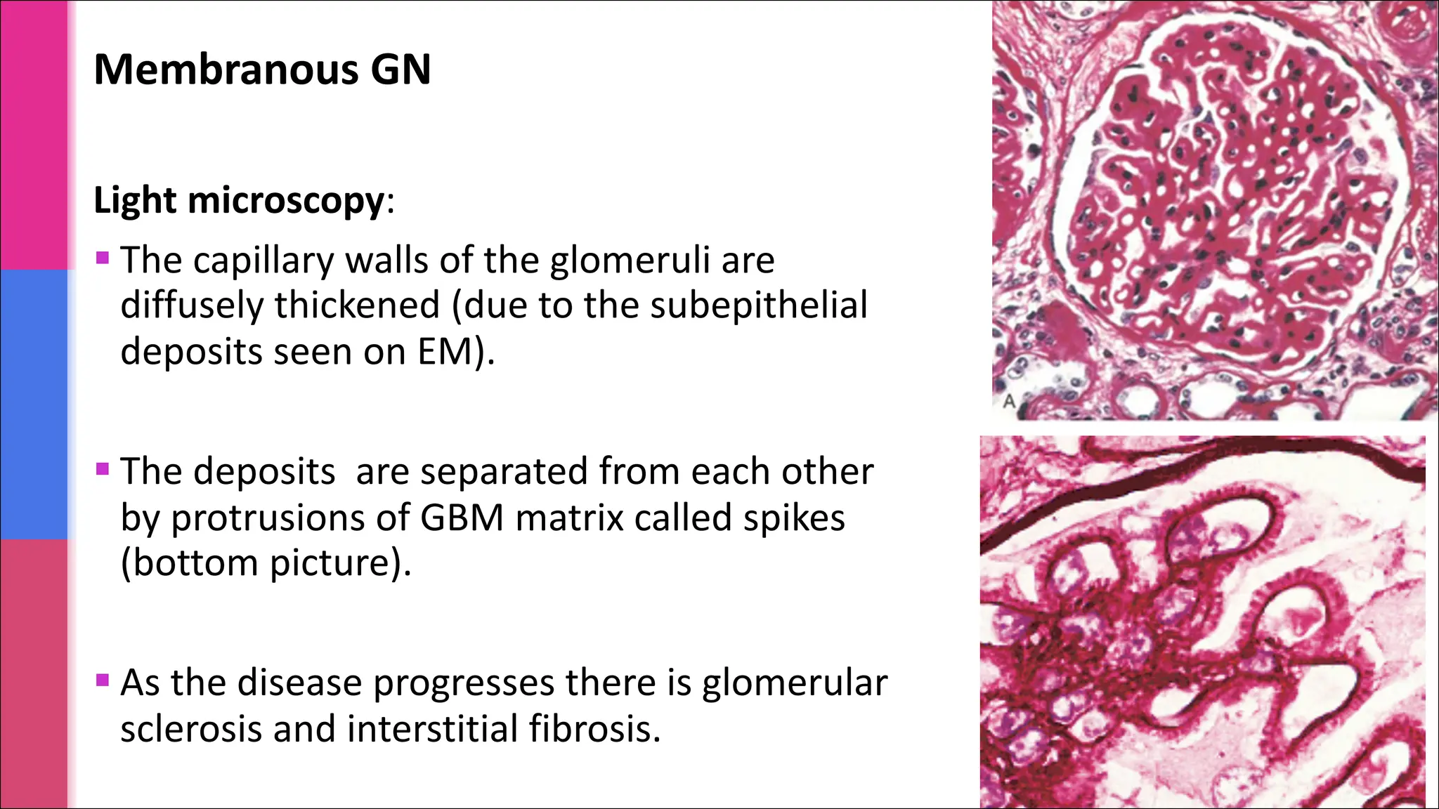 Membranous GN
Light microscopy:
§ The capillary walls of the glomeruli are
diffusely thickened (due to the subepithelial
deposits seen on EM).
§ The deposits are separated from each other
by protrusions of GBM matrix called spikes
(bottom picture).
§ As the disease progresses there is glomerular
sclerosis and interstitial fibrosis.
 