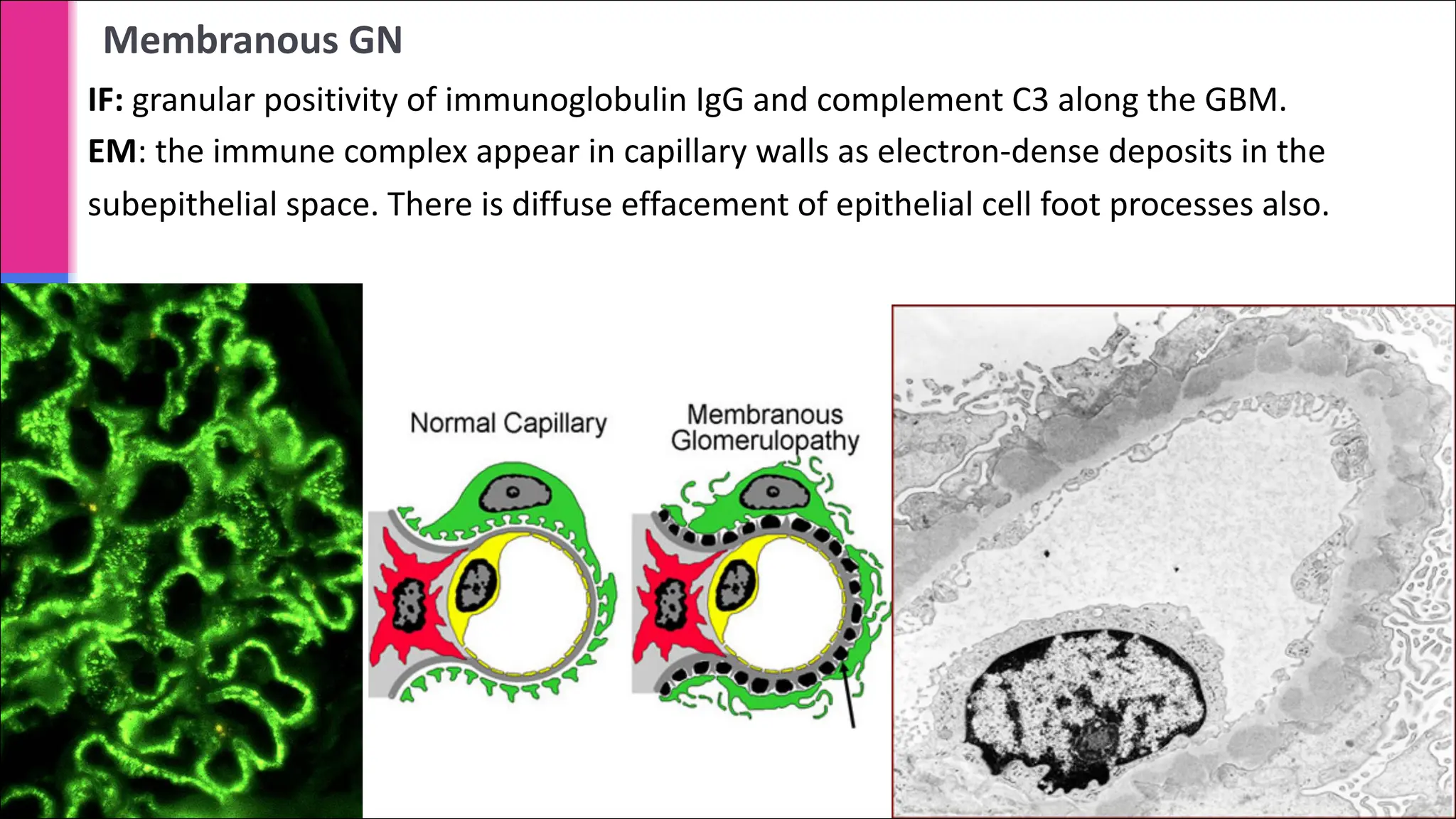 Membranous GN
IF: granular positivity of immunoglobulin IgG and complement C3 along the GBM.
EM: the immune complex appear in capillary walls as electron-dense deposits in the
subepithelial space. There is diffuse effacement of epithelial cell foot processes also.
 