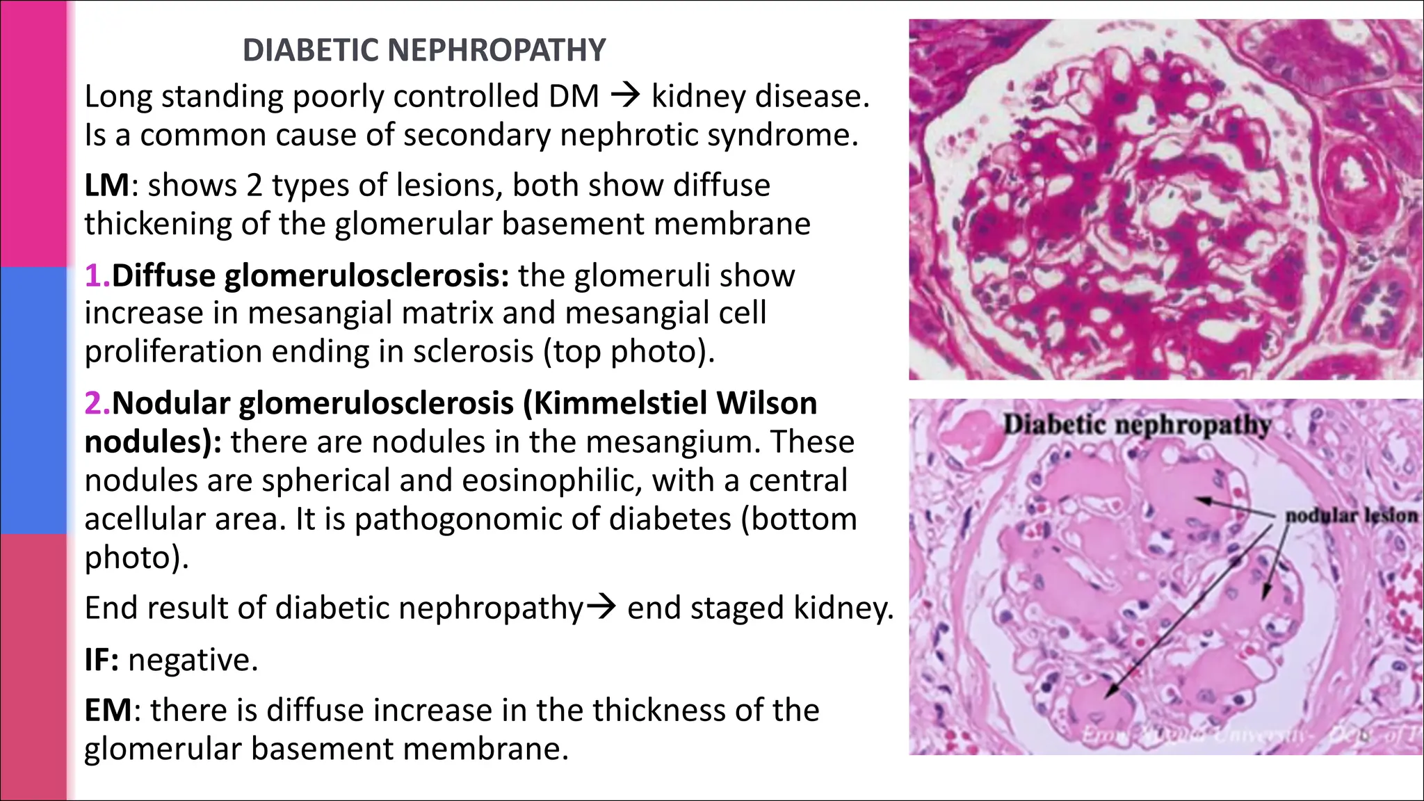 DIABETIC NEPHROPATHY
Long standing poorly controlled DM à kidney disease.
Is a common cause of secondary nephrotic syndrome.
LM: shows 2 types of lesions, both show diffuse
thickening of the glomerular basement membrane
1.Diffuse glomerulosclerosis: the glomeruli show
increase in mesangial matrix and mesangial cell
proliferation ending in sclerosis (top photo).
2.Nodular glomerulosclerosis (Kimmelstiel Wilson
nodules): there are nodules in the mesangium. These
nodules are spherical and eosinophilic, with a central
acellular area. It is pathogonomic of diabetes (bottom
photo).
End result of diabetic nephropathyà end staged kidney.
IF: negative.
EM: there is diffuse increase in the thickness of the
glomerular basement membrane.
 