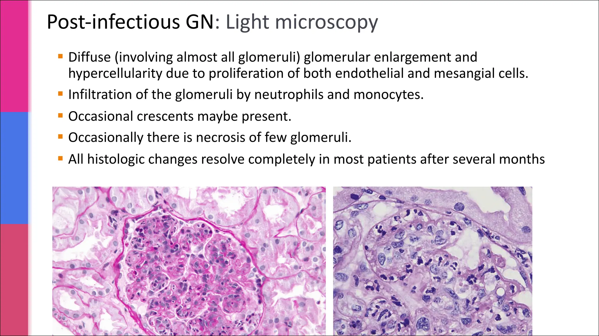 Post-infectious GN: Light microscopy
§ Diffuse (involving almost all glomeruli) glomerular enlargement and
hypercellularity due to proliferation of both endothelial and mesangial cells.
§ Infiltration of the glomeruli by neutrophils and monocytes.
§ Occasional crescents maybe present.
§ Occasionally there is necrosis of few glomeruli.
§ All histologic changes resolve completely in most patients after several months
 