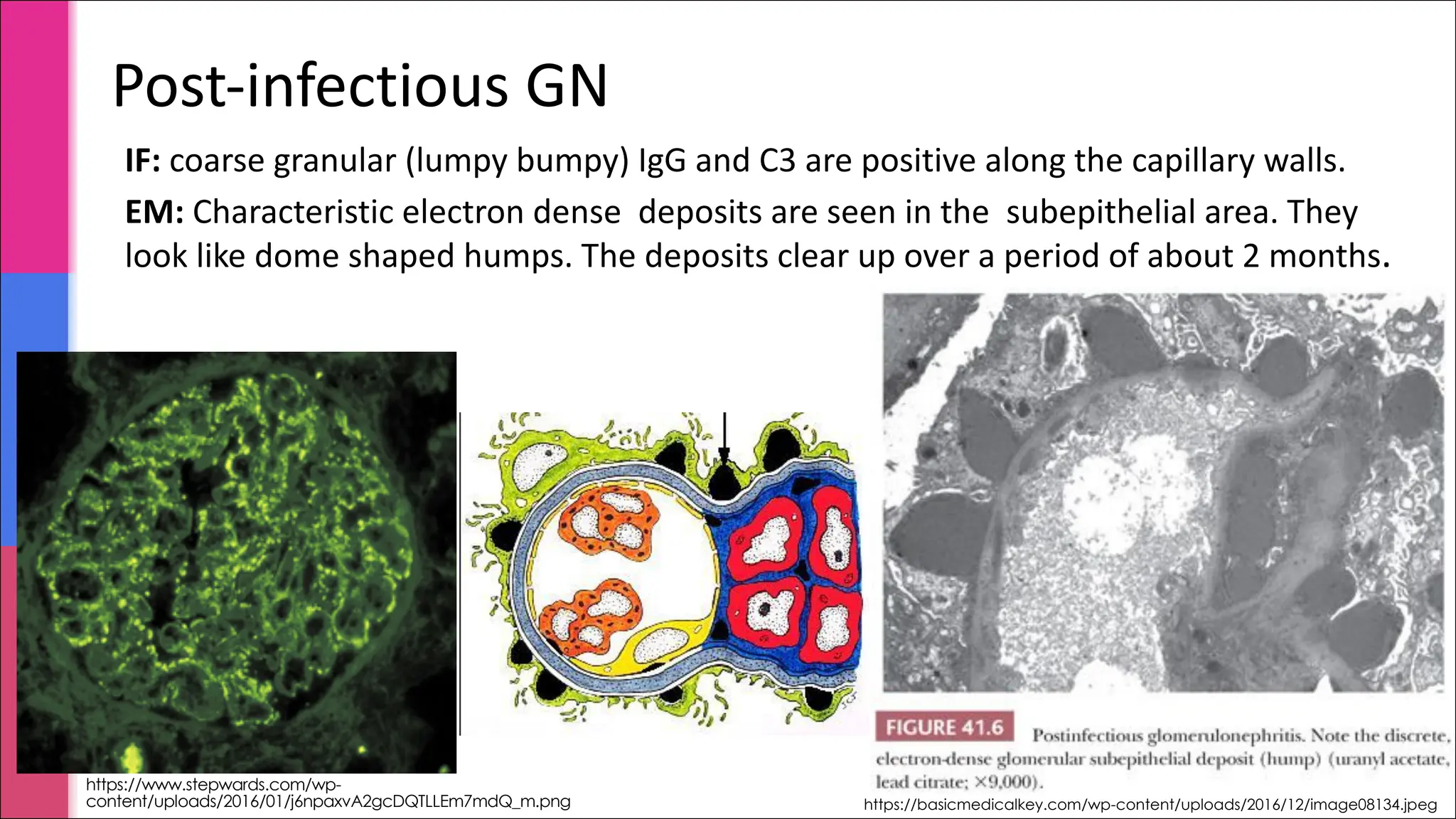 https://www.stepwards.com/wp-
content/uploads/2016/01/j6npaxvA2gcDQTLLEm7mdQ_m.png
IF: coarse granular (lumpy bumpy) IgG and C3 are positive along the capillary walls.
EM: Characteristic electron dense deposits are seen in the subepithelial area. They
look like dome shaped humps. The deposits clear up over a period of about 2 months.
Post-infectious GN
https://basicmedicalkey.com/wp-content/uploads/2016/12/image08134.jpeg
 
