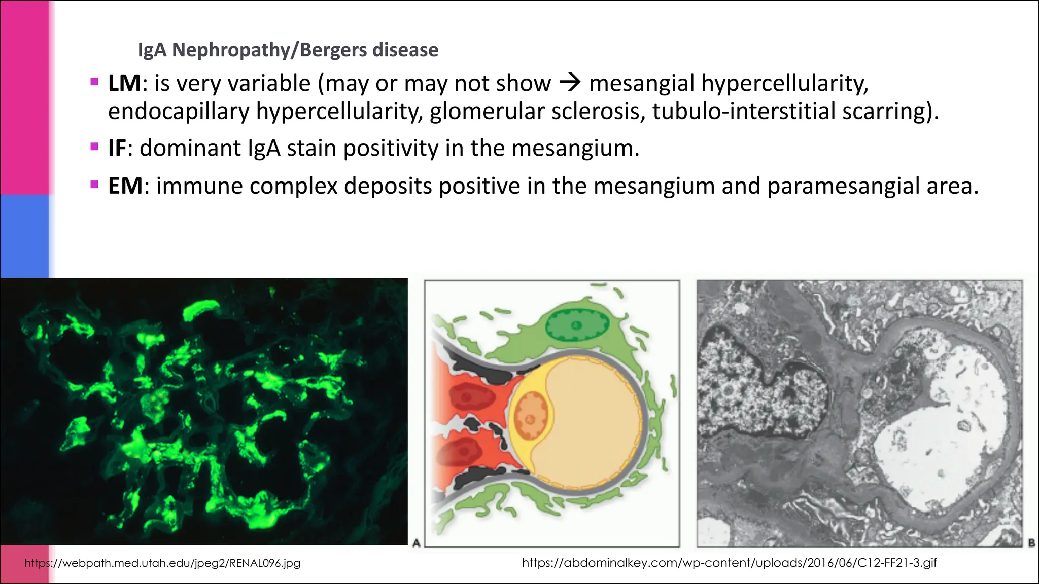 IgA Nephropathy/Bergers disease
§ LM: is very variable (may or may not show à mesangial hypercellularity,
endocapillary hypercellularity, glomerular sclerosis, tubulo-interstitial scarring).
§ IF: dominant IgA stain positivity in the mesangium.
§ EM: immune complex deposits positive in the mesangium and paramesangial area.
https://webpath.med.utah.edu/jpeg2/RENAL096.jpg https://abdominalkey.com/wp-content/uploads/2016/06/C12-FF21-3.gif
 