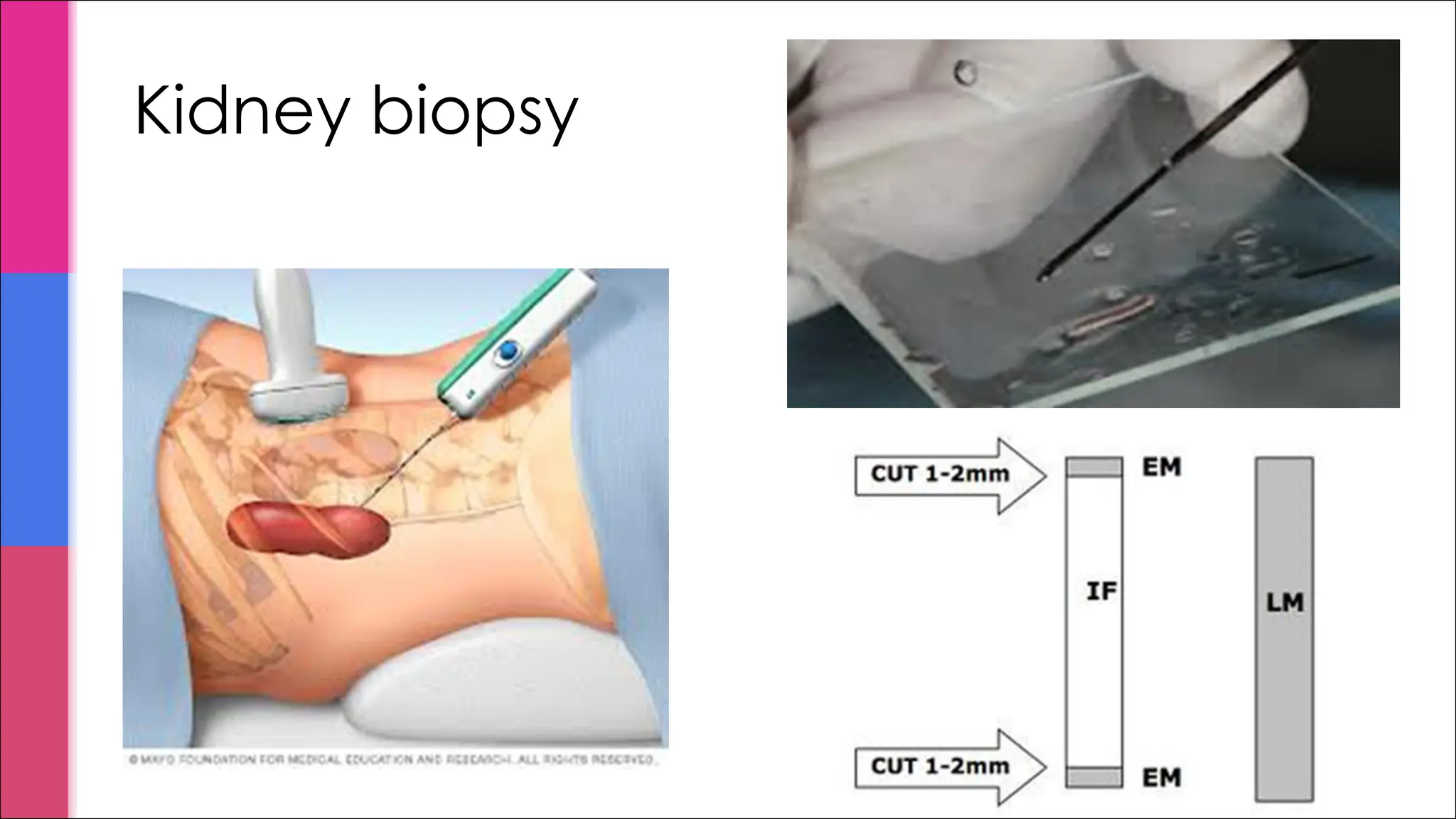 Kidney biopsy
 