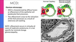 MCD:
Electron microscopy:
• MCD is characterized by diffuse fusion
or effacement of the epithelial cell
(podocyte) foot processes.
• This effacement is due to the retraction
of the foot processes as a result of
extensive cell swelling.
NOTE: effacement occurs in virtually all
cases of nephrotic proteinuria; it is not
specific for minimal-change
glomerulopathy.
 