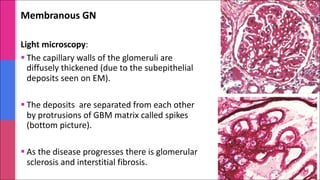 Membranous GN
Light microscopy:
§ The capillary walls of the glomeruli are
diffusely thickened (due to the subepithelial
deposits seen on EM).
§ The deposits are separated from each other
by protrusions of GBM matrix called spikes
(bottom picture).
§ As the disease progresses there is glomerular
sclerosis and interstitial fibrosis.
 