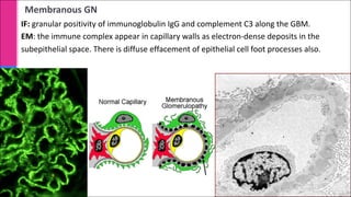 Membranous GN
IF: granular positivity of immunoglobulin IgG and complement C3 along the GBM.
EM: the immune complex appear in capillary walls as electron-dense deposits in the
subepithelial space. There is diffuse effacement of epithelial cell foot processes also.
 