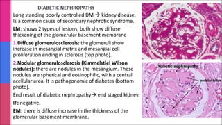 DIABETIC NEPHROPATHY
Long standing poorly controlled DM à kidney disease.
Is a common cause of secondary nephrotic syndrome.
LM: shows 2 types of lesions, both show diffuse
thickening of the glomerular basement membrane
1.Diffuse glomerulosclerosis: the glomeruli show
increase in mesangial matrix and mesangial cell
proliferation ending in sclerosis (top photo).
2.Nodular glomerulosclerosis (Kimmelstiel Wilson
nodules): there are nodules in the mesangium. These
nodules are spherical and eosinophilic, with a central
acellular area. It is pathogonomic of diabetes (bottom
photo).
End result of diabetic nephropathyà end staged kidney.
IF: negative.
EM: there is diffuse increase in the thickness of the
glomerular basement membrane.
 