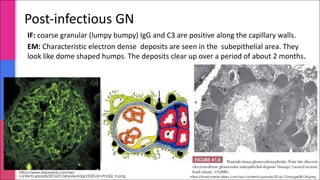 https://www.stepwards.com/wp-
content/uploads/2016/01/j6npaxvA2gcDQTLLEm7mdQ_m.png
IF: coarse granular (lumpy bumpy) IgG and C3 are positive along the capillary walls.
EM: Characteristic electron dense deposits are seen in the subepithelial area. They
look like dome shaped humps. The deposits clear up over a period of about 2 months.
Post-infectious GN
https://basicmedicalkey.com/wp-content/uploads/2016/12/image08134.jpeg
 