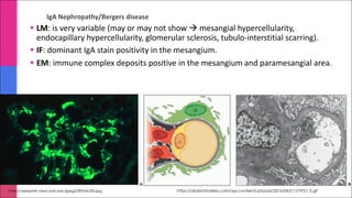 IgA Nephropathy/Bergers disease
§ LM: is very variable (may or may not show à mesangial hypercellularity,
endocapillary hypercellularity, glomerular sclerosis, tubulo-interstitial scarring).
§ IF: dominant IgA stain positivity in the mesangium.
§ EM: immune complex deposits positive in the mesangium and paramesangial area.
https://webpath.med.utah.edu/jpeg2/RENAL096.jpg https://abdominalkey.com/wp-content/uploads/2016/06/C12-FF21-3.gif
 
