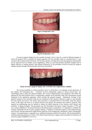 Gummy smile and optimization of dentofacial esthetics
DOI: 10.9790/0853-144XXXXX www.iosrjournals.org 2 | Page
Fig.1c; Preoperative view
Fig.1d; Preoperative view
Excessive gingival display has four possible etiologies. First, it may be a result of delayed eruption in
which the gingivae fail to complete the apical migration over the maxillary teeth to a position that is 1 mm
coronal to the cement-enamel junctions.[ 4,5] In these patients, restoring the normal dentogingival relationships
can be achieved with an esthetic crown lengthening, which is a well documented treatment modality that is
highly effective in treating patients with delayed eruption.[6,7] The procedure involves moving the gingival
margins apically through soft and possibly hard tissue resection[7]
Fig.2a ;Excessive gingival display due to attrition and compensatory eruption.
The second possibility is vertical maxillary excess in which there is an enlarged vertical dimension of
the midface and incompetent lips. Treatment involves orthognathic surgery to restore normal inter- jaw
relationships and to reduce the gingival display; this involves hospitalization and significant side effects for
patients.[8] The third possible cause is compensatory eruption of the maxillary teeth with concomitant coronal
migration of the attachment apparatus, which includes the gingival margins. Orthodontic leveling of the
gingival margins of the maxillary teeth may be considered in this situation. Resective surgery is also possible
but may expose the narrow root surface and necessitate a restoration.[9,10,11,12] Finally, when the patient
smiles, if the upper lip moves in an apical direction and exposes the dentition and excessive gingivae, then
surgical lip repositioning may be utilized to reduce the labial retraction of the elevator smile muscle and
minimize he gingival display. This procedure was first described in the plastic surgery literature in 1973 and
was recently published in the dental literature.[10] During patient examination, it is important to establish the
etiology responsible for the excessive gingival display. A diagnosis of delayed eruption, tooth malpositioning,
and excessive skeletal deformities might best be treated by crown lengthening, orthodontics, and/or orthognathic
surgery. Lip repositioning is suggested as an additional treatment modality for patients with lip hypermobility
exposing undesired gingivae in a smile. This clinical report describes a gingivectomy procedure for reduction of
excessive gingival display[13,14,15,16,]
 