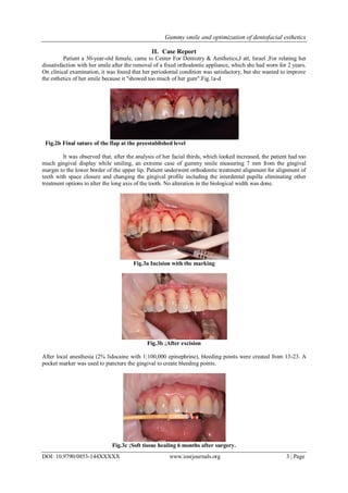 Gummy smile and optimization of dentofacial esthetics
DOI: 10.9790/0853-144XXXXX www.iosrjournals.org 3 | Page
II. Case Report
Patient a 30-year-old female, came to Center For Dentistry & Aesthetics,J att, Israel ,For relating her
dissatisfaction with her smile after the removal of a fixed orthodontic appliance, which she had worn for 2 years.
On clinical examination, it was found that her periodontal condition was satisfactory, but she wanted to improve
the esthetics of her smile because it "showed too much of her gum".Fig.1a-d
Fig.2b Final suture of the flap at the preestablished level
It was observed that, after the analysis of her facial thirds, which looked increased, the patient had too
much gingival display while smiling, an extreme case of gummy smile measuring 7 mm from the gingival
margin to the lower border of the upper lip. Patient underwent orthodontic treatment alignment for alignment of
teeth with space closure and changing the gingival profile including the interdental papilla eliminating other
treatment options to alter the long axis of the tooth. No alteration in the biological width was done.
Fig.3a Incision with the marking
Fig.3b ;After excision
After local anesthesia (2% lidocaine with 1:100,000 epinephrine), bleeding points were created from 13-23. A
pocket marker was used to puncture the gingival to create bleeding points.
Fig.3c ;Soft tissue healing 6 months after surgery.
 