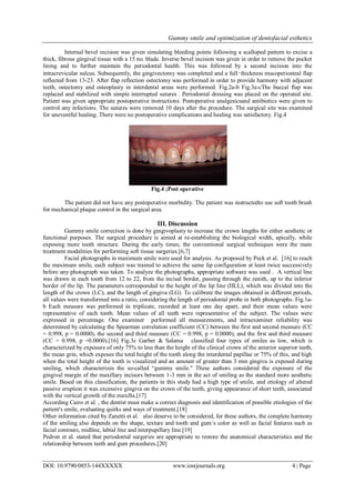 Gummy smile and optimization of dentofacial esthetics
DOI: 10.9790/0853-144XXXXX www.iosrjournals.org 4 | Page
Internal bevel incision was given simulating bleeding points following a scalloped pattern to excise a
thick, fibrous gingival tissue with a 15 no. blade. Inverse bevel incision was given in order to remove the pocket
lining and to further maintain the periodontal health. This was followed by a second incision into the
intracrevicular sulcus. Subsequently, the gingivectomy was completed and a full‑thickness mucoperiosteal flap
reflected from 13-23. After flap reflection ostectomy was performed in order to provide harmony with adjacent
teeth, ostectomy and osteoplasty in interdental areas were performed. Fig.2a-b Fig.3a-cThe buccal flap was
replaced and stabilized with simple interrupted sutures . Periodontal dressing was placed on the operated site.
Patient was given appropriate postoperative instructions. Postoperative analgesicsand antibiotics were given to
control any infections. The sutures were removed 10 days after the procedure. The surgical site was examined
for uneventful healing. There were no postoperative complications and healing was satisfactory. Fig.4
Fig.4 ;Post operative
The patient did not have any postoperative morbidity. The patient was instructedto use soft tooth brush
for mechanical plaque control in the surgical area.
III. Discussion
Gummy smile correction is done by gingivoplasty to increase the crown lengths for either aesthetic or
functional purposes. The surgical procedure is aimed at re-establishing the biological width, apically, while
exposing more tooth structure. During the early times, the conventional surgical techniques were the main
treatment modalities for performing soft tissue surgeries.[6,7]
Facial photographs in maximum smile were used for analysis. As proposed by Peck et al. [16] to reach
the maximum smile, each subject was trained to achieve the same lip configuration at least twice successively
before any photograph was taken. To analyze the photographs, appropriate software was used . A vertical line
was drawn in each tooth from 12 to 22, from the incisal border, passing through the zenith, up to the inferior
border of the lip. The parameters corresponded to the height of the lip line (HLL), which was divided into the
length of the crown (LC), and the length of gingiva (LG). To calibrate the images obtained in different periods,
all values were transformed into a ratio, considering the length of periodontal probe in both photographs. Fig.1a-
b Each measure was performed in triplicate, recorded at least one day apart, and their mean values were
representative of each tooth. Mean values of all teeth were representative of the subject. The values were
expressed in percentage. One examiner performed all measurements, and intraexaminer reliability was
determined by calculating the Spearman correlation coefficient (CC) between the first and second measure (CC
= 0.998, p = 0.0000), the second and third measure (CC = 0.998, p = 0.0000), and the first and third measure
(CC = 0.998, p =0.0000).[16] Fig.3c Garber & Salama classified four types of smiles as low, which is
characterized by exposure of only 75% to less than the height of the clinical crown of the anterior superior teeth,
the mean grin, which exposes the total height of the tooth along the interdental papillae or 75% of this, and high
when the total height of the tooth is visualized and an amount of greater than 3 mm gingiva is exposed during
smiling, which characterizes the so-called “gummy smile." These authors considered the exposure of the
gingival margin of the maxillary incisors between 1-3 mm in the act of smiling as the standard more aesthetic
smile. Based on this classification, the patients in this study had a high type of smile, and etiology of altered
passive eruption it was excessive gingiva on the crown of the teeth, giving appearance of short teeth, associated
with the vertical growth of the maxilla.[17]
According Cairo et al. , the dentist must make a correct diagnosis and identification of possible etiologies of the
patient's smile, evaluating quirks and ways of treatment.[18]
Other information cited by Zanetti et al. also deserve to be considered, for these authors, the complete harmony
of the smiling also depends on the shape, texture and tooth and gum´s color as well as facial features such as
facial contours, midline, labial line and interpupillary line.[19]
Pedron et al. stated that periodontal surgeries are appropriate to restore the anatomical characteristics and the
relationship between teeth and gum procedures.[20]
 