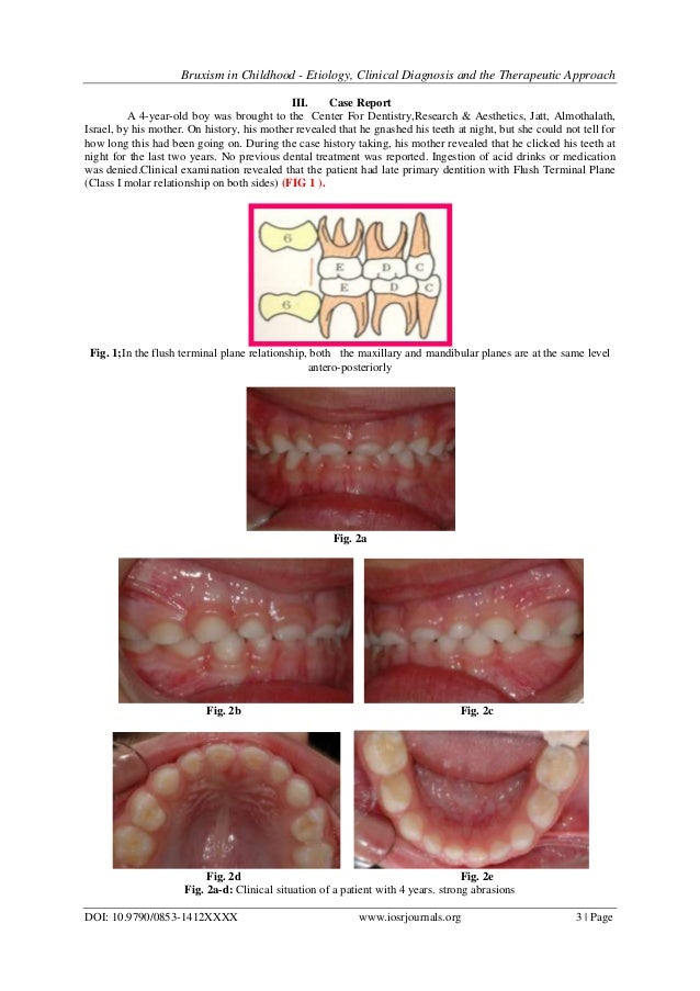 Bruxism in Childhood Etiology, Clinical Diagnosis and the Therapeut…