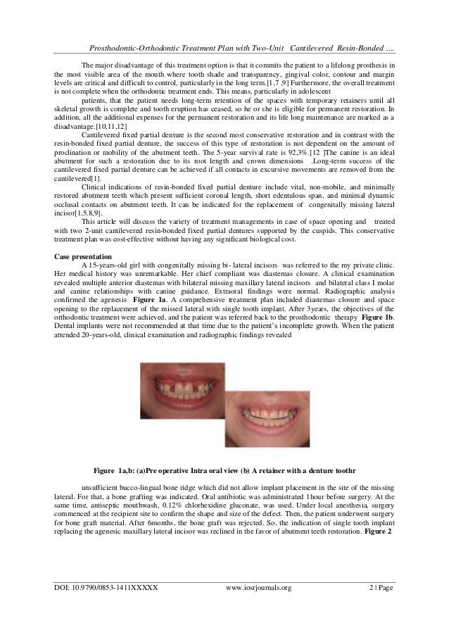 ProsthodonticOrthodontic Treatment Plan with TwoUnit Cantilevered R…