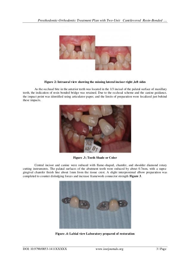 ProsthodonticOrthodontic Treatment Plan with TwoUnit Cantilevered R…
