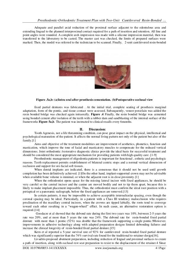 ProsthodonticOrthodontic Treatment Plan with TwoUnit Cantilevered R…