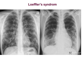 Loeffler’s syndrom
 