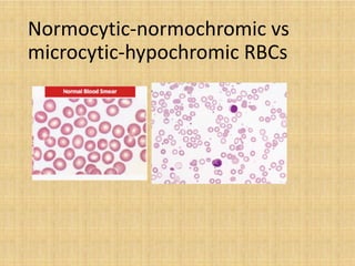 Normocytic Rbc L7 Approach to anemia Edited v3.pptx.pdf
