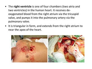 The  right ventricle  is one of four chambers (two atria and two ventricles) in the human heart. It receives de-oxygenated blood from the right atrium via the tricuspid valve, and pumps it into the pulmonary artery via the pulmonary valve. It is triangular in form, and extends from the right atrium to near the apex of the heart. 
