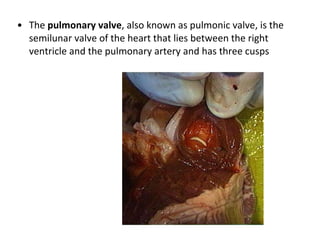 The  pulmonary valve , also known as pulmonic valve, is the semilunar valve of the heart that lies between the right ventricle and the pulmonary artery and has three cusps  