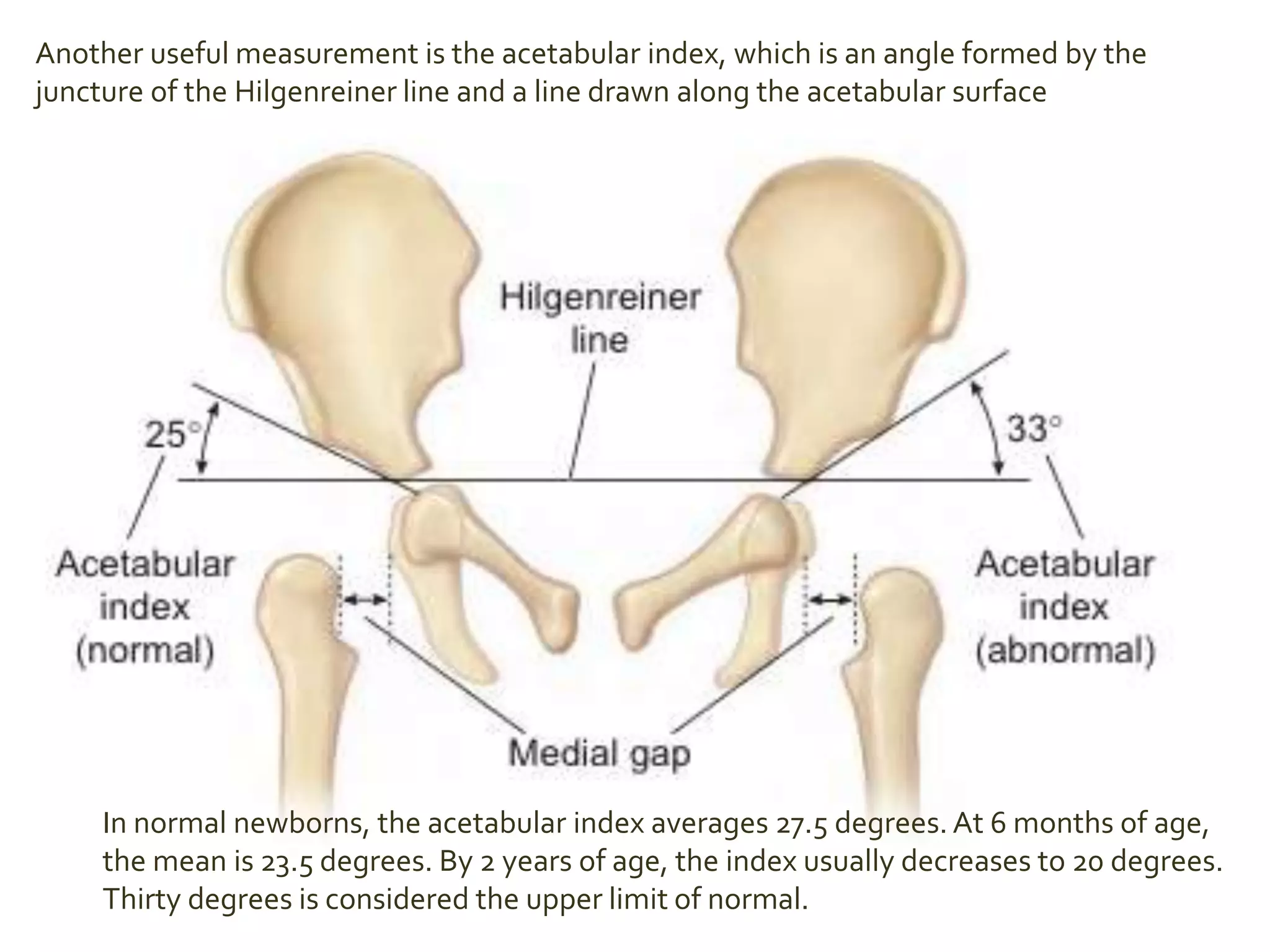 Another useful measurement is the acetabular index, which is an angle formed by the
juncture of the Hilgenreiner line and a line drawn along the acetabular surface
In normal newborns, the acetabular index averages 27.5 degrees. At 6 months of age,
the mean is 23.5 degrees. By 2 years of age, the index usually decreases to 20 degrees.
Thirty degrees is considered the upper limit of normal.
 