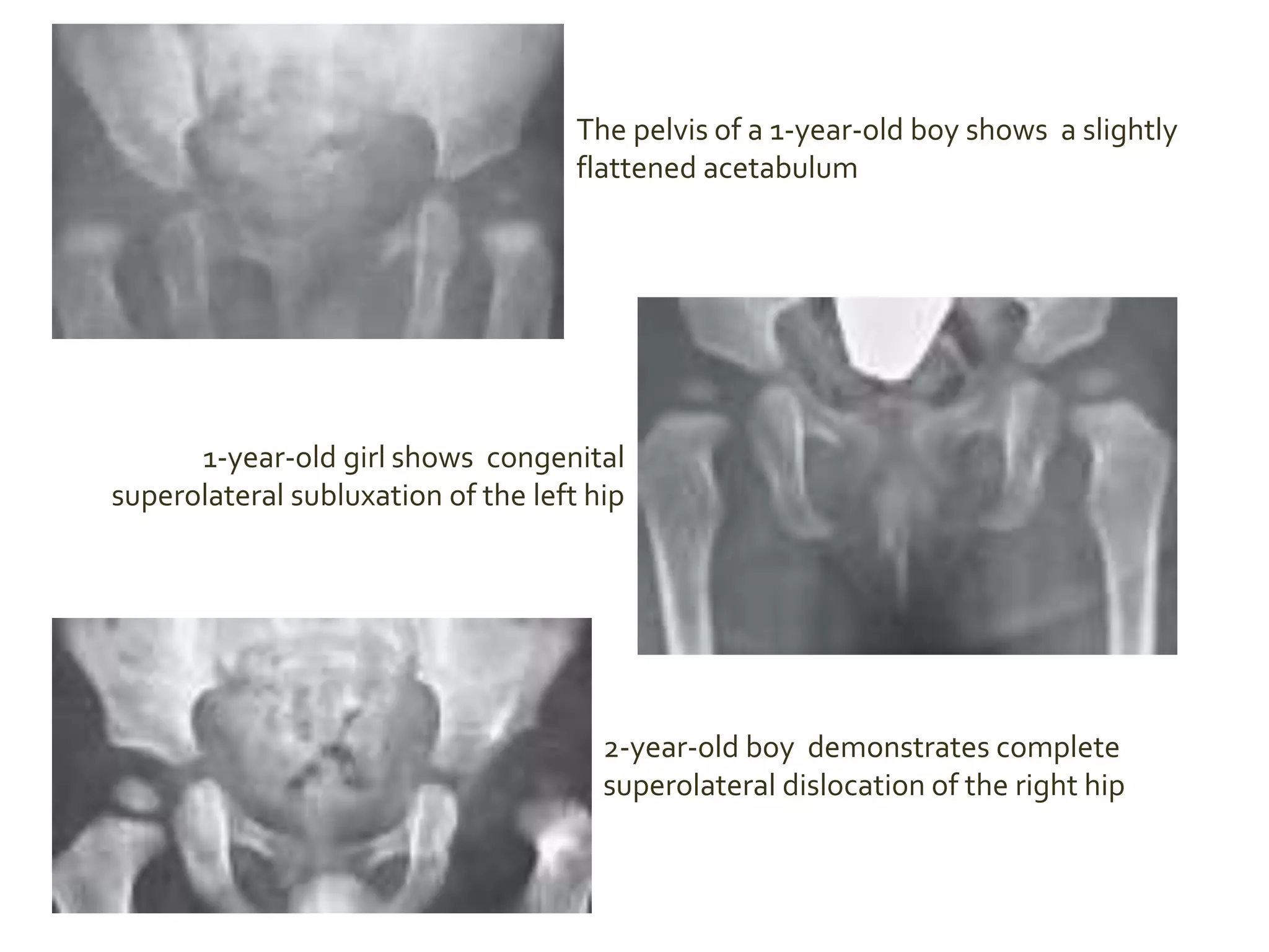 The pelvis of a 1-year-old boy shows a slightly
flattened acetabulum
1-year-old girl shows congenital
superolateral subluxation of the left hip
2-year-old boy demonstrates complete
superolateral dislocation of the right hip
 