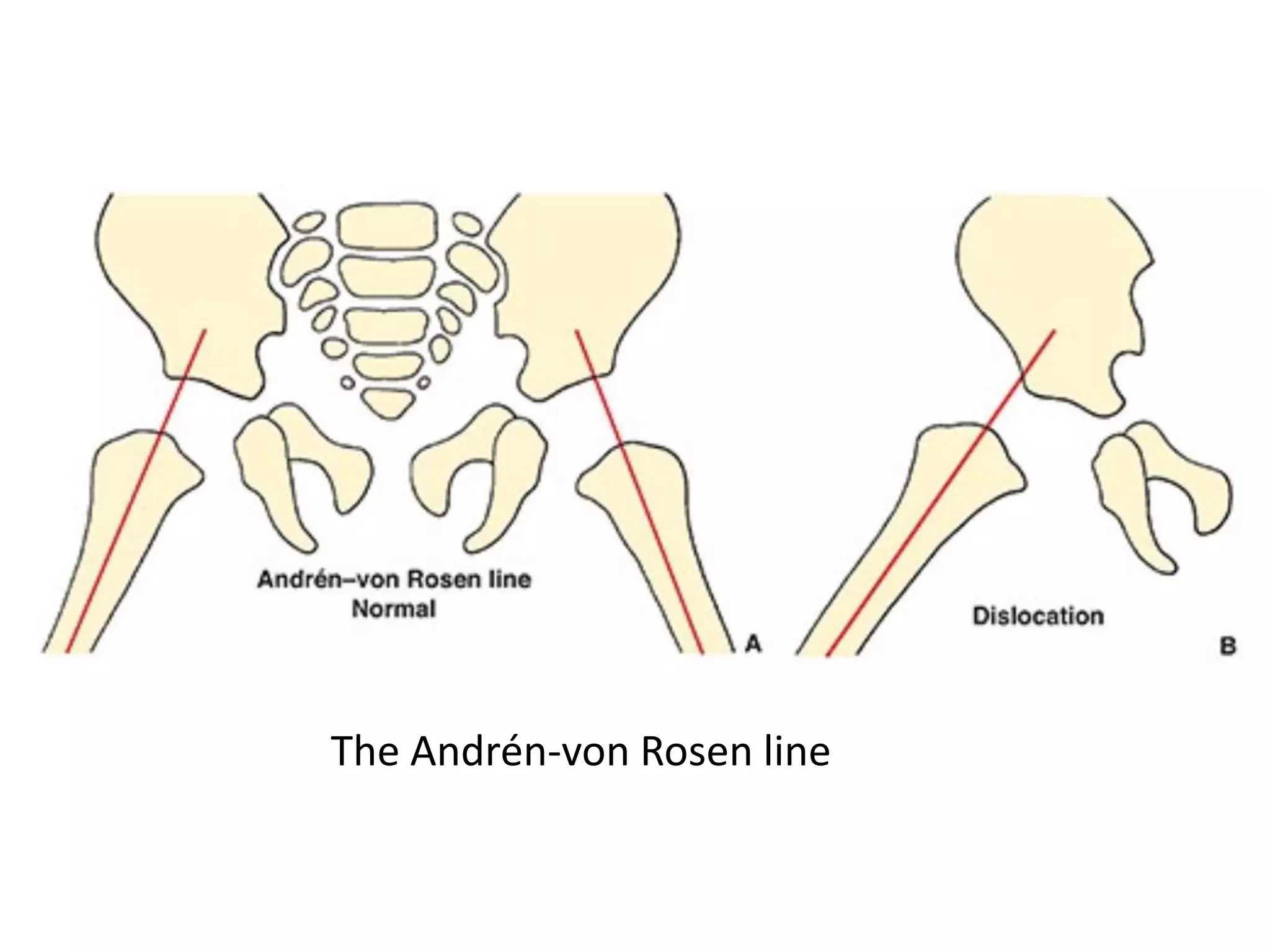 The Andrén-von Rosen line
 