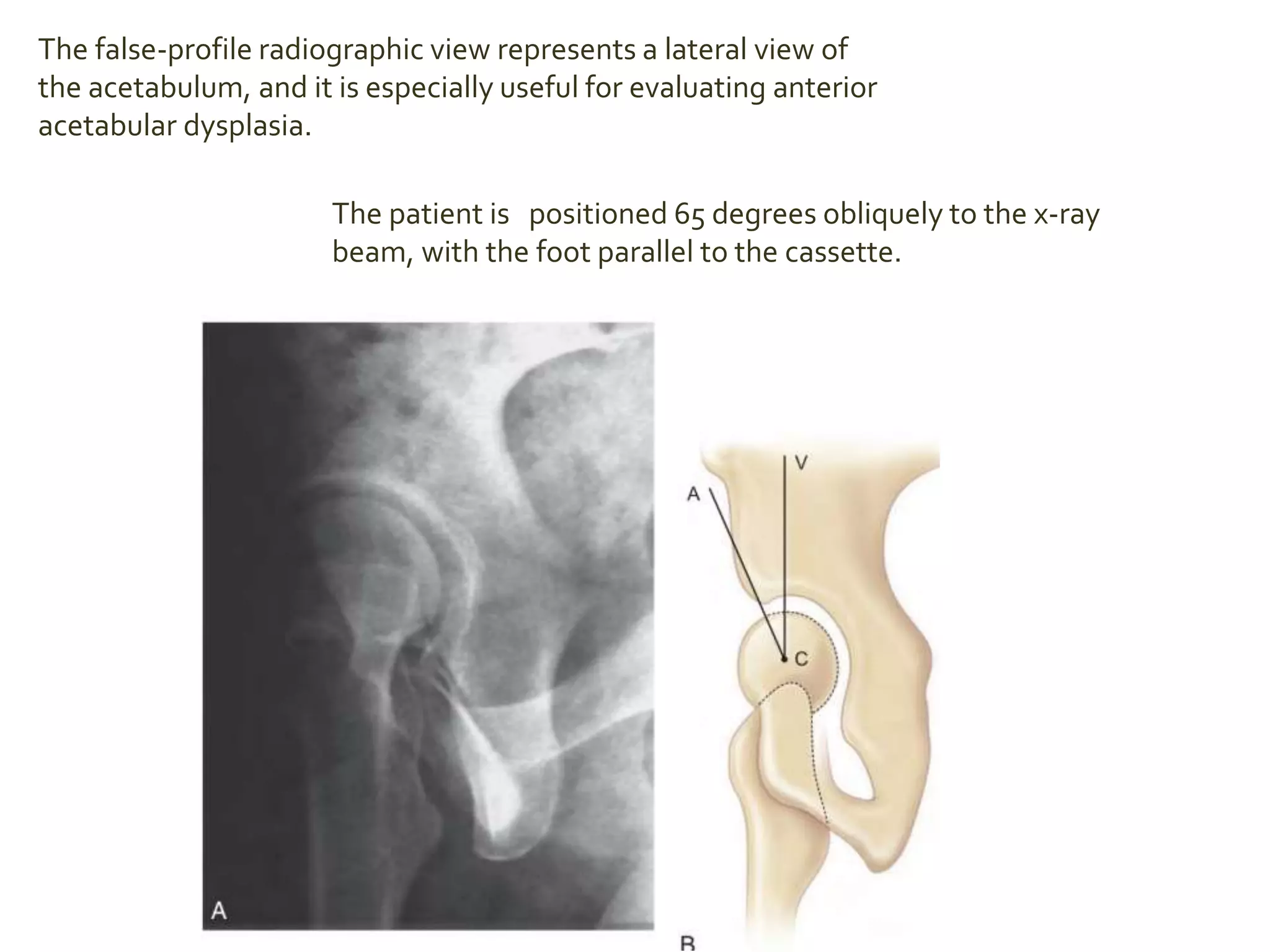 The false-profile radiographic view represents a lateral view of
the acetabulum, and it is especially useful for evaluating anterior
acetabular dysplasia.
The patient is positioned 65 degrees obliquely to the x-ray
beam, with the foot parallel to the cassette.
 