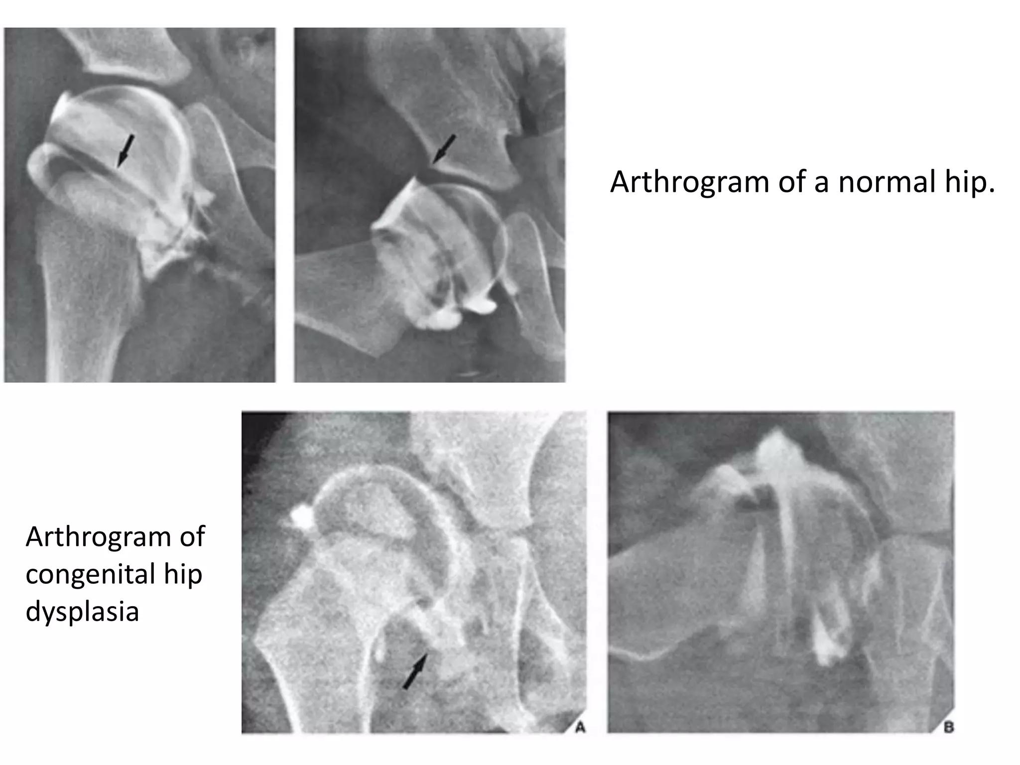 Arthrogram of a normal hip.
Arthrogram of
congenital hip
dysplasia
 