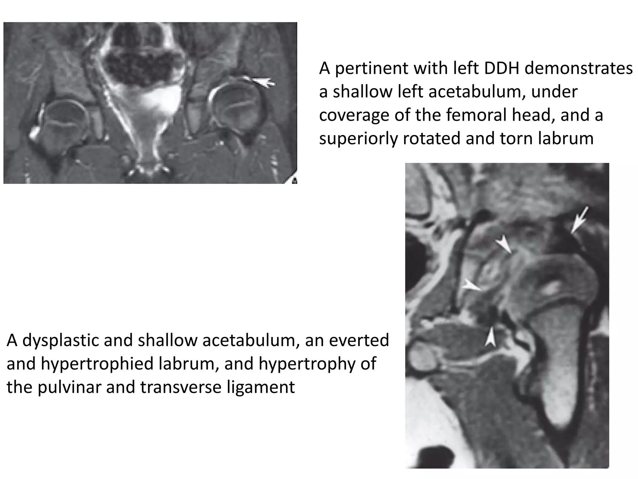 A pertinent with left DDH demonstrates
a shallow left acetabulum, under
coverage of the femoral head, and a
superiorly rotated and torn labrum
A dysplastic and shallow acetabulum, an everted
and hypertrophied labrum, and hypertrophy of
the pulvinar and transverse ligament
 