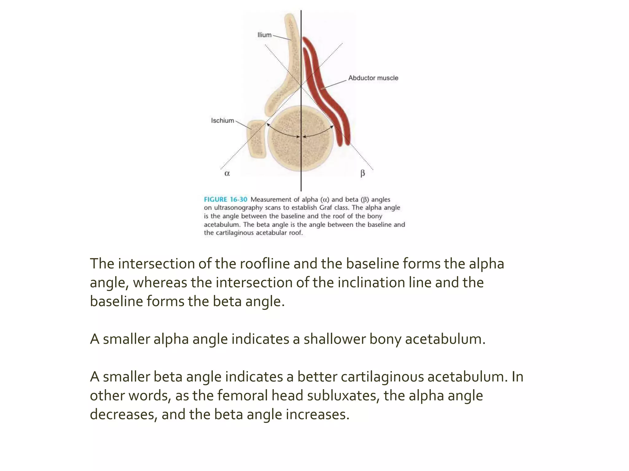 The intersection of the roofline and the baseline forms the alpha
angle, whereas the intersection of the inclination line and the
baseline forms the beta angle.
A smaller alpha angle indicates a shallower bony acetabulum.
A smaller beta angle indicates a better cartilaginous acetabulum. In
other words, as the femoral head subluxates, the alpha angle
decreases, and the beta angle increases.
 
