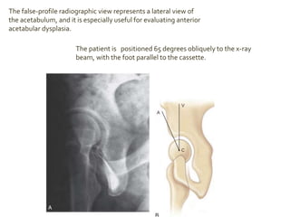 Developmental Dysplasia of Hip Radiological findings | PPTX