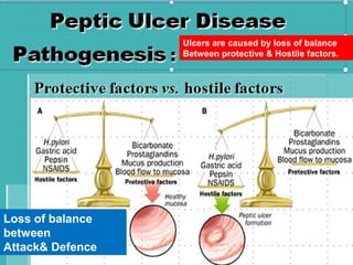 L Ulcers are caused by loss of balance
Between protective & Hostile factors.

Loss of balance
between
Attack& Defence

 