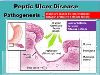 Ulcers are caused by loss of balance
Between protective & Hostile factors.
Loss of balance
between
Attack& Defence

 