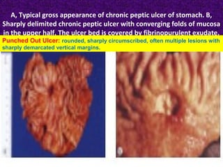 A, Typical gross appearance of chronic peptic ulcer of stomach. B,
Sharply delimited chronic peptic ulcer with converging folds of mucosa
in the upper half. The ulcer bed is covered by fibrinopurulent exudate.

Punched Out Ulcer: rounded, sharply circumscribed, often multiple lesions with
sharply demarcated vertical margins.

 