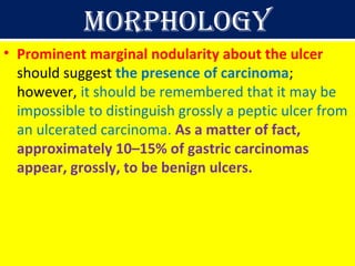 Morphology
• Prominent marginal nodularity about the ulcer
should suggest the presence of carcinoma;
however, it should be remembered that it may be
impossible to distinguish grossly a peptic ulcer from
an ulcerated carcinoma. As a matter of fact,
approximately 10–15% of gastric carcinomas
appear, grossly, to be benign ulcers.

 