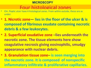 MICROSCOPY

•

Four histological zones

Chr. Peptic ulcer have 4 histological zones. From within outside, these are as
under:

• 1. Nicrotic zone— lies in the floor of the ulcer & is
composed of fibrinous exudate containing necrotic
debris & a few leukocytes.
• 2. Superficial exudative zone –lies underneath the
necrotic zone. The tissue elements here show
coagulative necrosis giving eosinophilic, smudgy
appearance with nuclear debris.
• 3. Granulation tissue zone– is seen merging into
the necrotic zone. It is composed of nonspecific
inflammatory infiltrate & proliferative capillaries.

 