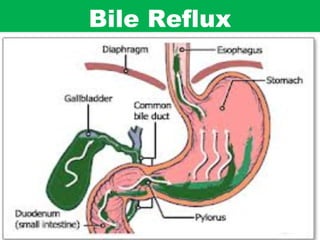 Bile Reflux

 