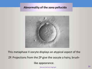 Maryam Borhani-Haghighi 39
This metaphase II oocyte displays an atypical aspect of the
ZP. Projections from the ZP give the oocyte a hairy, brush-
like appearance.
Abnormality of the zona pellucida
 