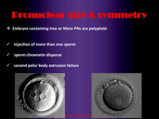 Maryam Borhani-Haghighi
Pronuclear size & symmetry
 Embryos containing tree or More PNs are polyploid:
 injection of more than one sperm
 sperm chromatin disperse
 second polar body extrusion failure
 