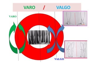 VARO
VALGO
VARO / VALGO
 