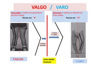VALGO
VARO
VALGO / VARO
Genuvaro = Joelhos se afastam da
linha média.
Pernas em “O”
Genuvalgo = Joelhos de aproximam
da linha média.
Pernas em “X”
Linha Média
Corporal
O vértice
aproxima
o vértice
se afasta
 