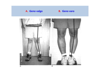 A. Geno valgo B. Geno varo
 